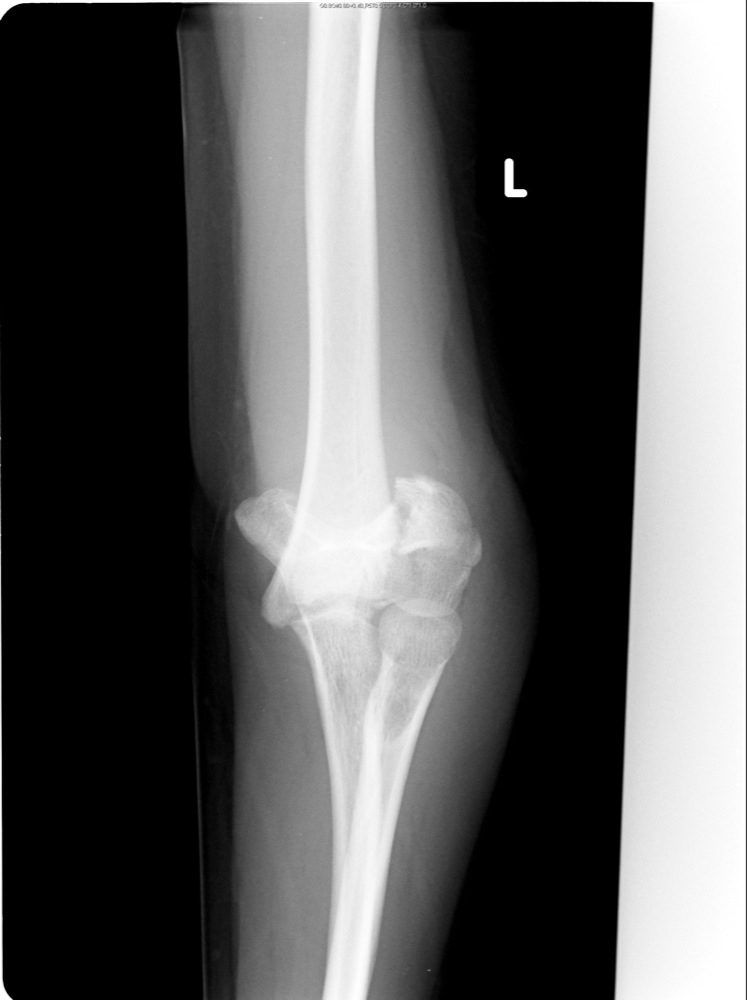 Elbow X Ray Fracture 6782